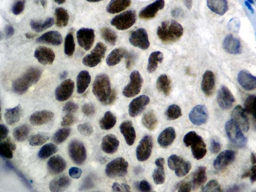 IHC of Cyclin E1 on an FFPE Breast Carcinoma Tissue